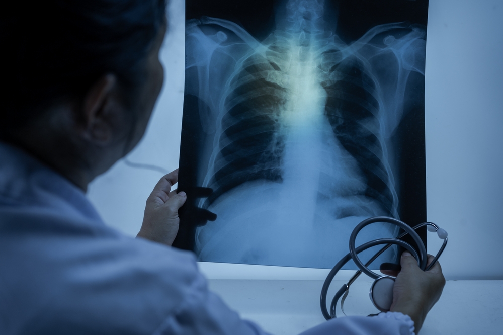 Doctor,Hand,Point,Patient,Lung,X-ray,Film,Before,Treatment,For